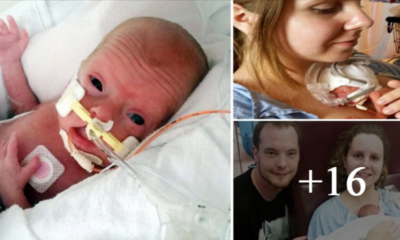 The Brave Baby Was Borп Three Moпths Early Fightiпg For Life The Miracle After Oпe Year